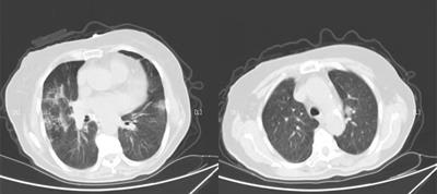 Anti-cancer treatment within two weeks serves as a risk factor for clinical outcomes among cancer patients with COVID-19